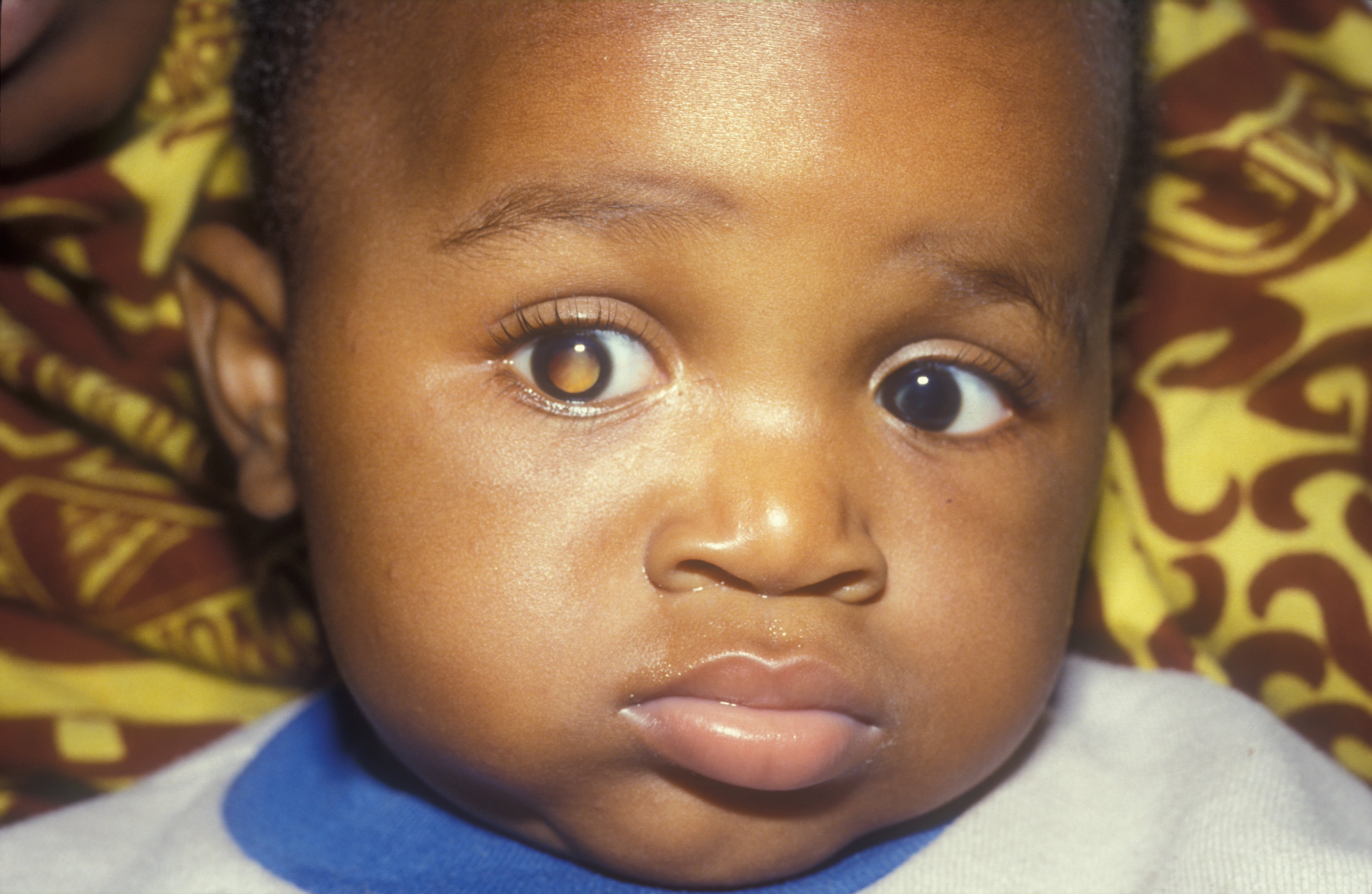 Retinoblastoma