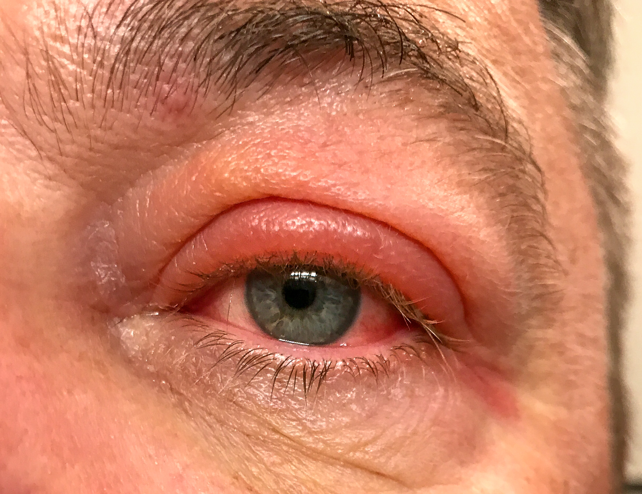 swollen eyelids 2