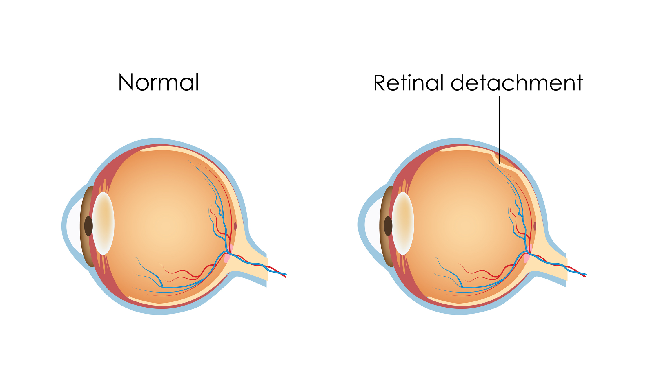 1673551027_Retinal