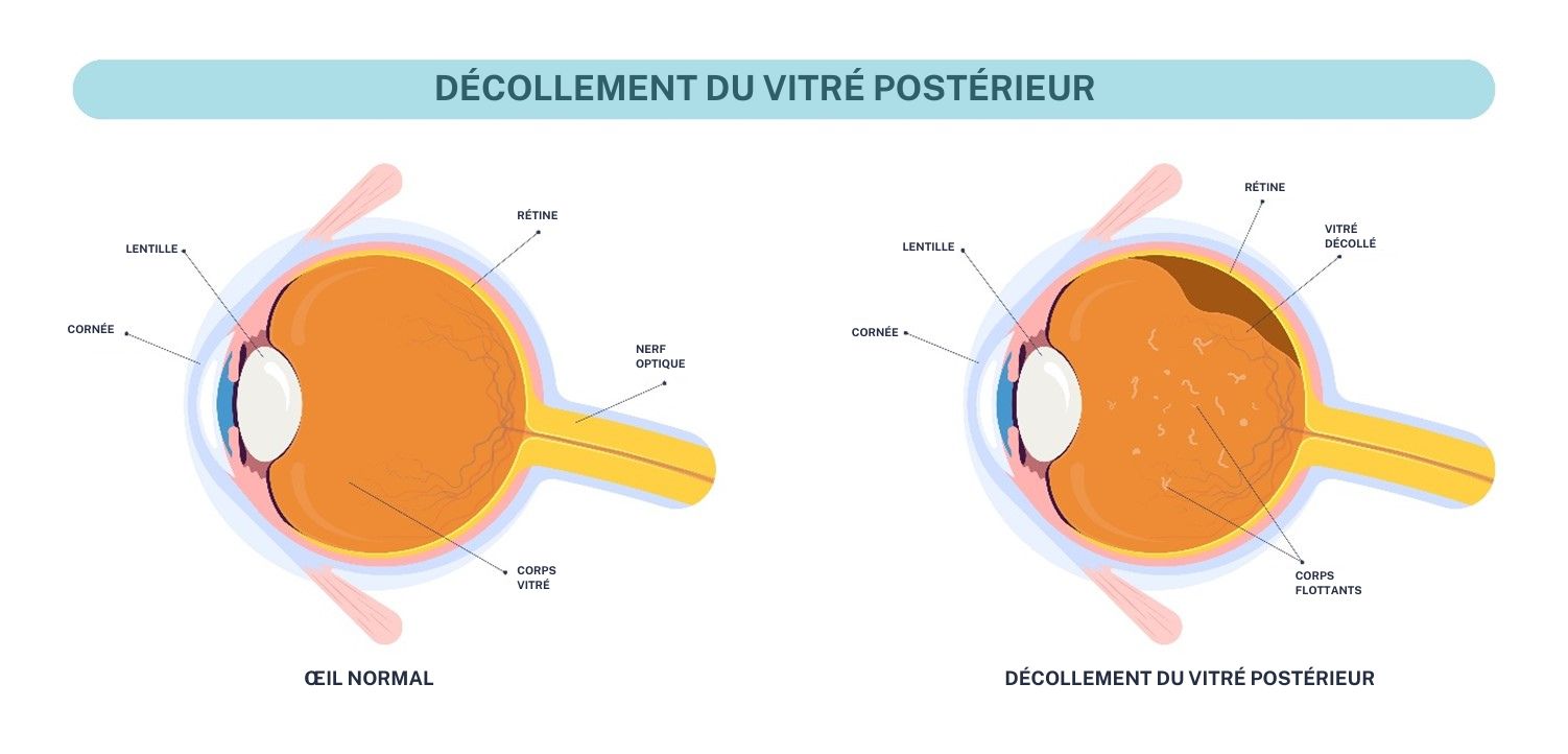 Vitreous detachment. FR