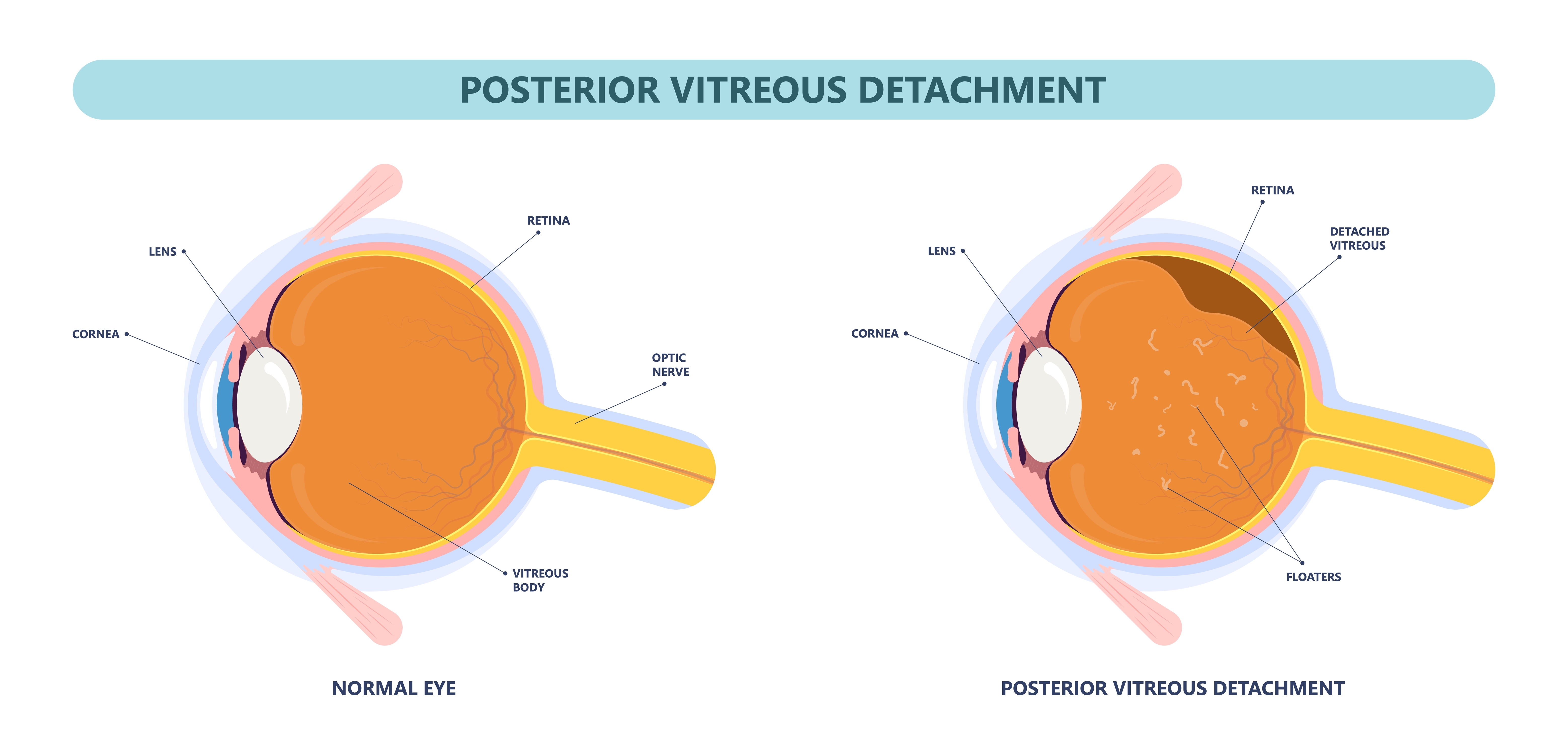 Vitreous detachment
