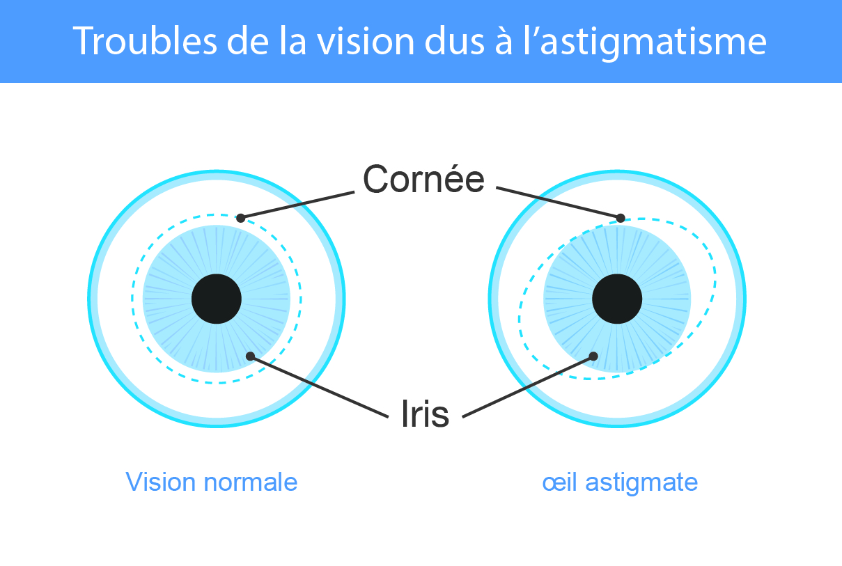 Illustration comparant un œil avec une vision normale à un œil astigmate. L'image montre la différence de courbure de la cornée entre les deux yeux. L'œil normal a une cornée ronde, tandis que l'œil astigmate a une cornée de forme irrégulière. Les éléments de l'œil comme la cornée et l’iris sont étiquetés.